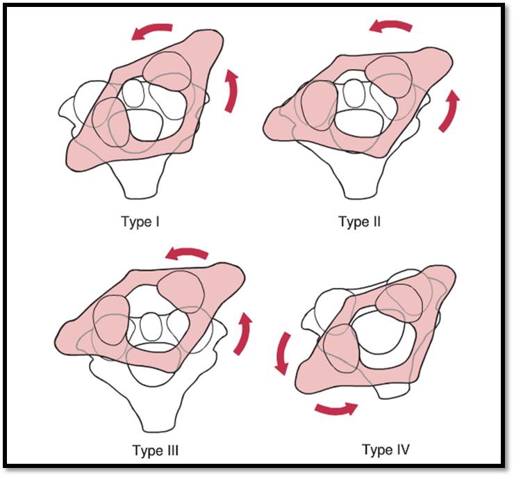 Figure 2: Fielding and Hawkins Classification Ref: Fielding JW, Hawkins RJ. Atlanto-axial rotatory fixation. (Fixed rotatory subluxation of the atlanto-axial joint). The Journal of bone and joint surgery. American volume. Jan 1977;59(1):37-44.