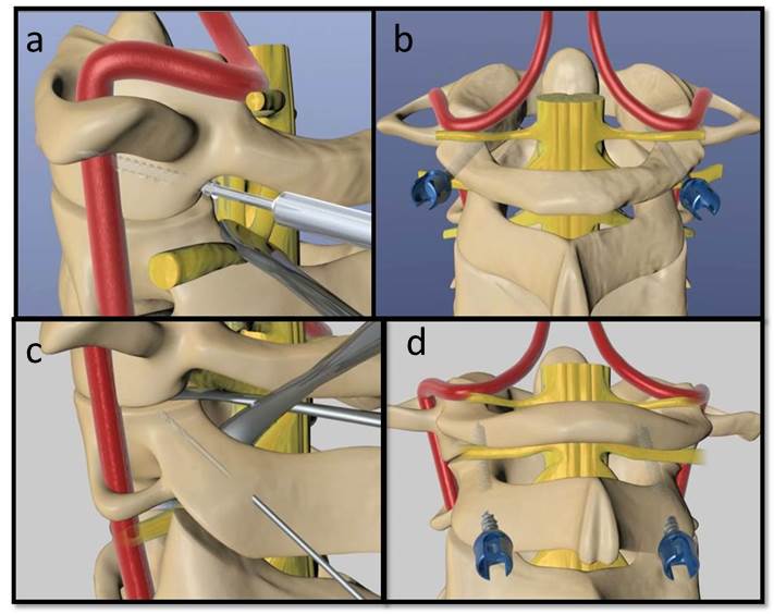 Figure 3. A,B - Location for screw fixation C1 lateral masses. C- Location of C2 pars screw fixation. D- Demonstrates a C1-C2 transarticular screw, the C2 pars screw has same orientation but should stop before crossing the C1-2 facet joint.