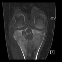 Chondroblastoma CT