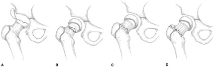 Figure 1: Delbet classification: A) Type I, B) Type II, C) Type III, D) Type IV