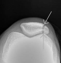 patella hairline fracture