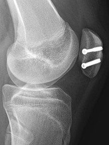 treatment for broken patella