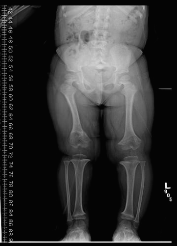 Figure 2:  AP standing lower extremity x-ray of a 4 year old reveals characteristic findings of achondroplasia, including champagne glass pelvis, short tubular long bones, flaring of the metaphysis and V-shaped physis of the distal femur.