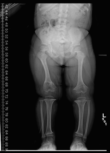 achondroplasia x ray vs normal