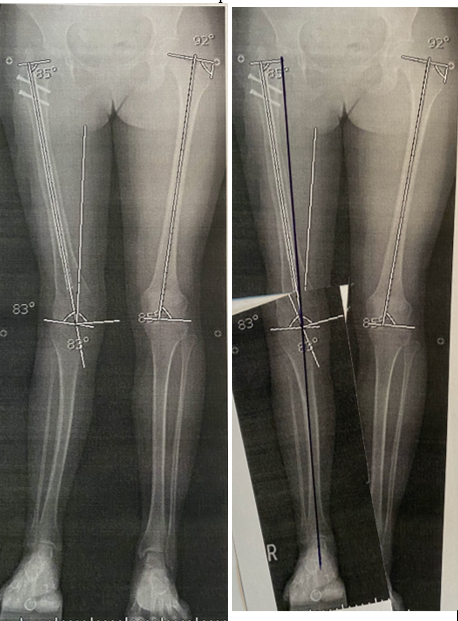 Tibia Lengthening and Deformity Correction With a Multiplanar External  Fixator