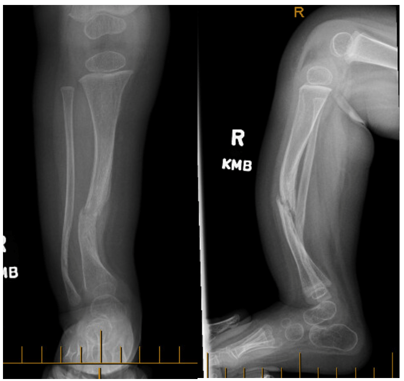 Congenital Pseudarthrosis of the Tibia (CPT)