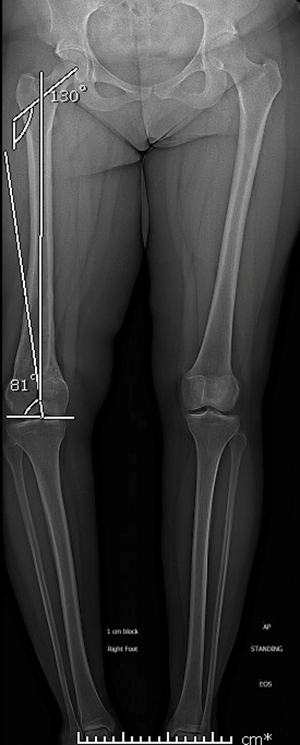 Deformity Correction: The Process  International Center for Limb