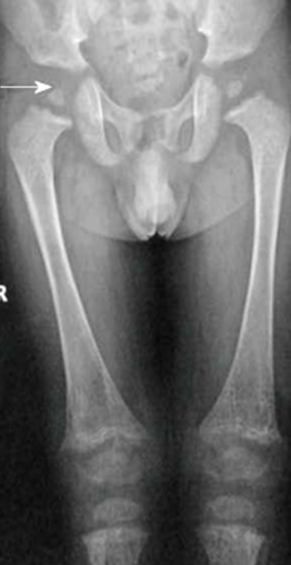 Spondyloepiphyseal-Dysplasia-Congenita-and-Tarda-fig-2.png