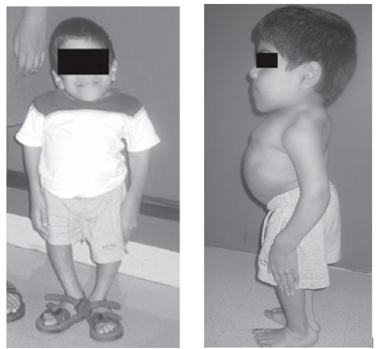 Spondyloepiphyseal-Dysplasia-Congenita-and-Tarda-fig-1.png