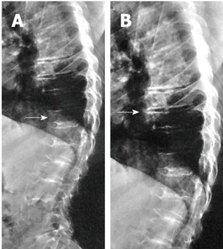 Spondyloepiphyseal-Dysplasia-Congenita-and-Tarda-fig-3.png