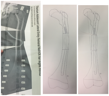 Deformity Correction: The Process  International Center for Limb