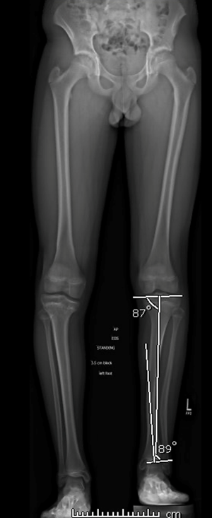 Deformity Correction: The Process  International Center for Limb