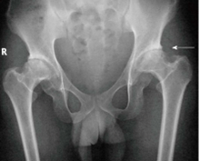 Spondyloepiphyseal-Dysplasia-Congenita-and-Tarda-fig-4.png