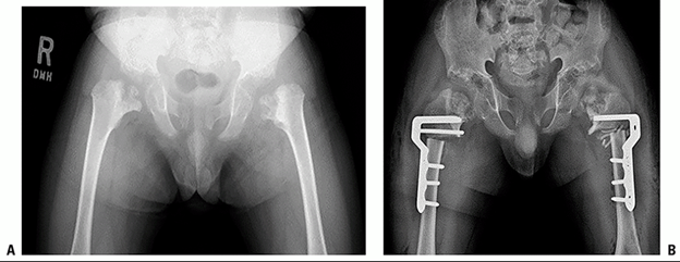 Spondyloepiphyseal-Dysplasia-Congenita-and-Tarda-fig-5.png