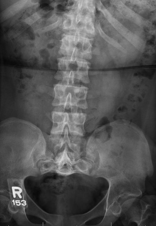 achondroplasia x ray baby