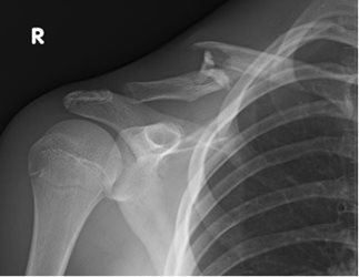 Figure 3a: 15 yo male injured in motor vehicle pedestrian accident.  Clavicle fracture with shortening and comminution.