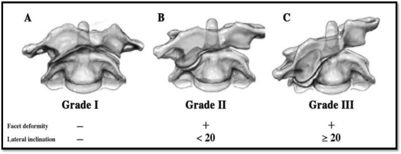 Figure 1: Classification for chronic AAR Fixation, demonstrating lateral inclination. Ref:  Ishii K, Chiba K, Maruiwa H, Nakamura M, Matsumoto M, Toyama Y. Pathognomonic radiological signs for predicting prognosis in patients with chronic atlantoaxial rotatory fixation. Journal of neurosurgery. Spine. Nov 2006;5(5):385-391.