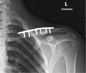 Figure 4c: 3 months after corrective osteotomy.