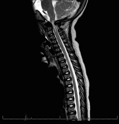 Figure 3a:  MRI of the craniocervical junction showing severe foramen magnum stenosis with impingement of the cervical cord in a 2 year old with achondroplasia. (Image courtesy of Vinitha Shenava, MD)