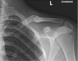 Figure 4b: Symptomatic malunion and subsequent refracture, 5 months from original injury.