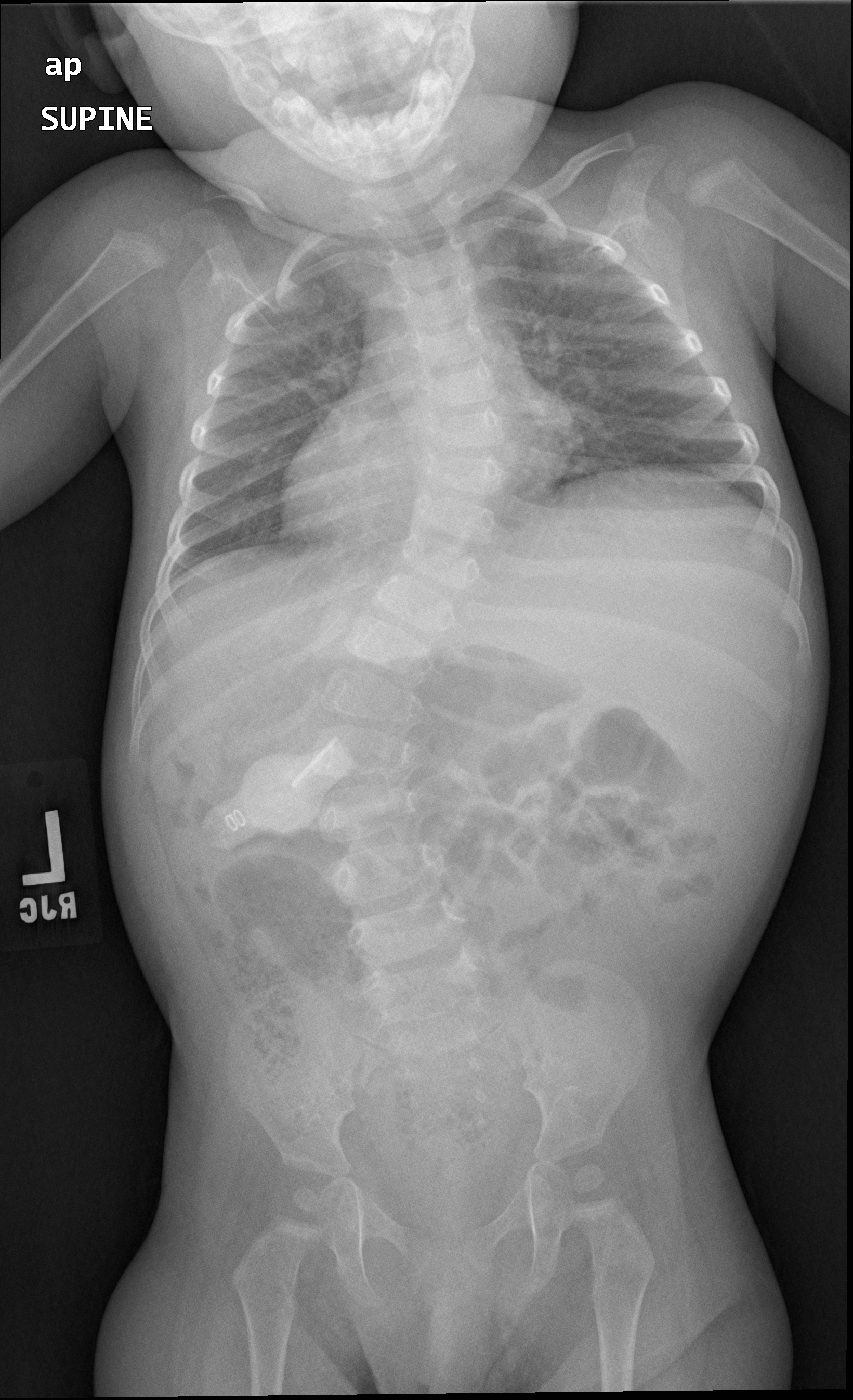 Myotonic Dystrophy | Pediatric Orthopaedic Society Of North America (POSNA)