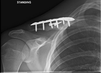 Figure 3b: Nine weeks postop.