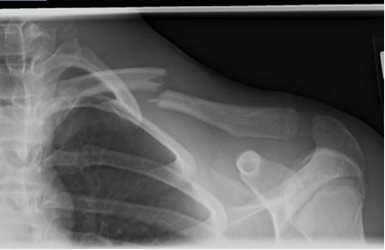 Figure 2a: 17 yo male injured while snowboarding