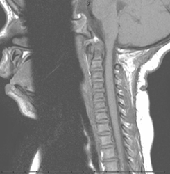 Fig 3b:  MRI of the same patient following occipital craniectomy with resection of a segment of the posterior arch of C1. (Image courtesy of Vinitha Shenava, MD)